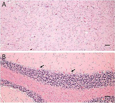 Pathological Study of a FMR1 Premutation Carrier With Progressive Supranuclear Palsy